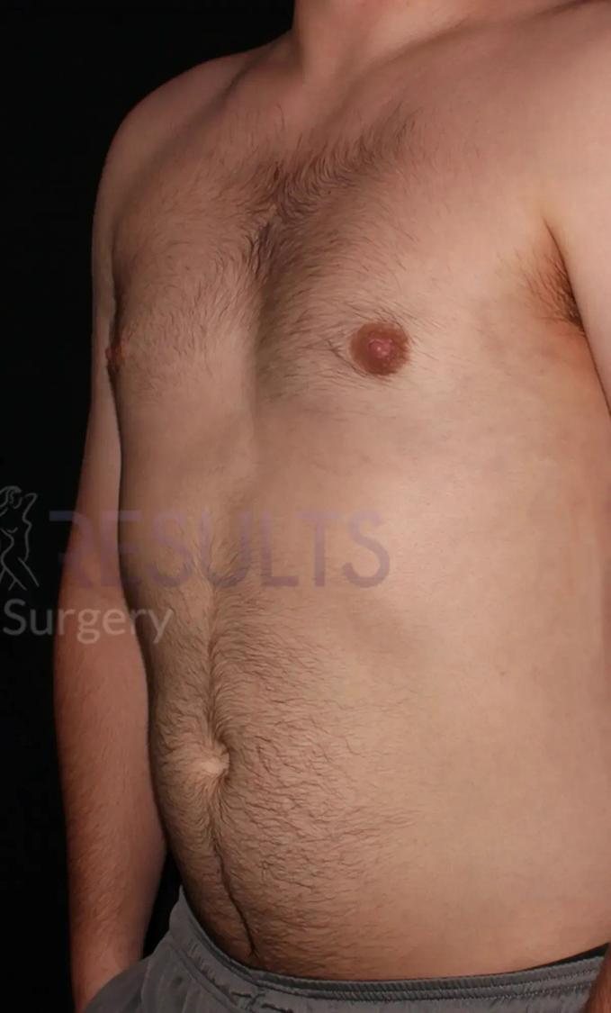One-Stitch Gynecomastia after