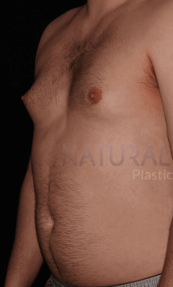 One-Stitch Gynecomastia before