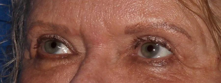 Eyelid Surgery after