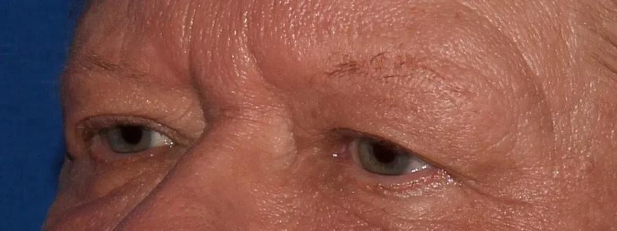 Eyelid Surgery before