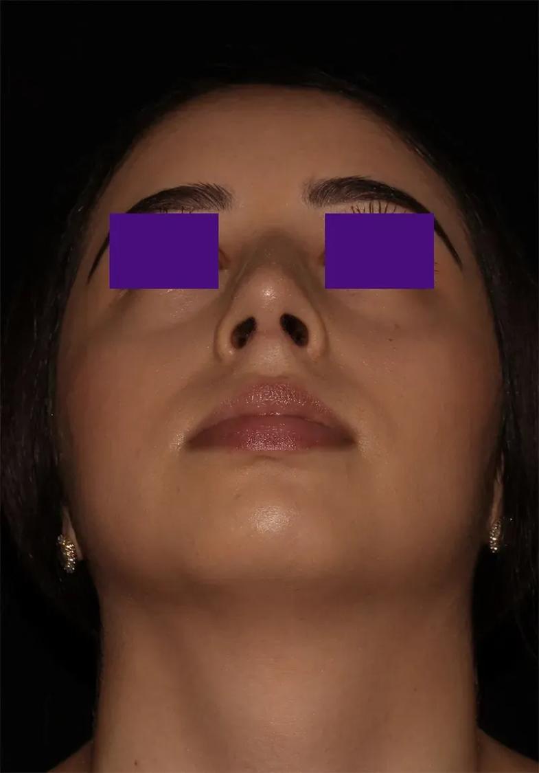 After Rhinoplasty