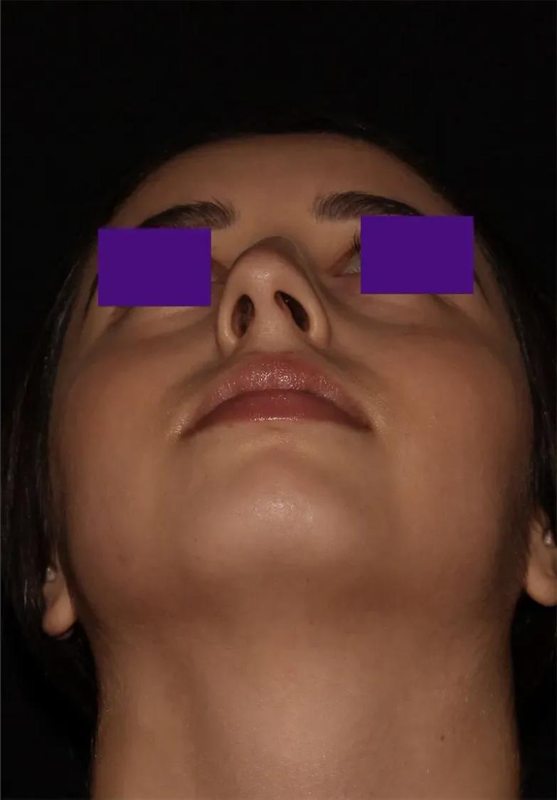 Before Rhinoplasty