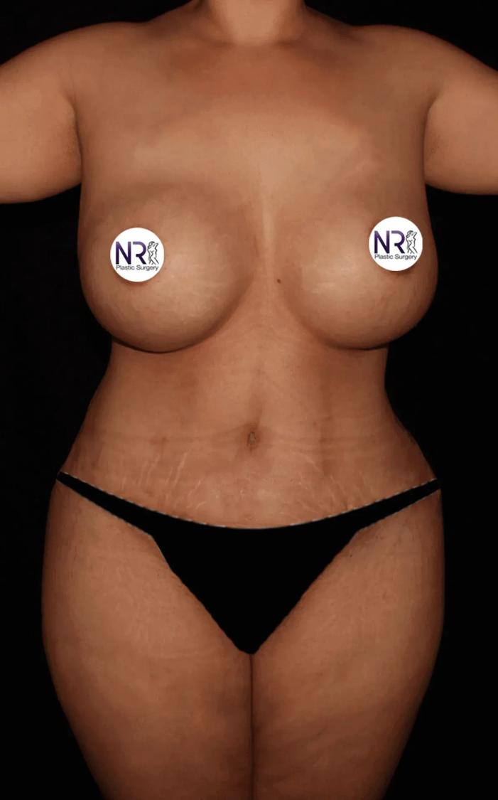 Tummy Tuck after
