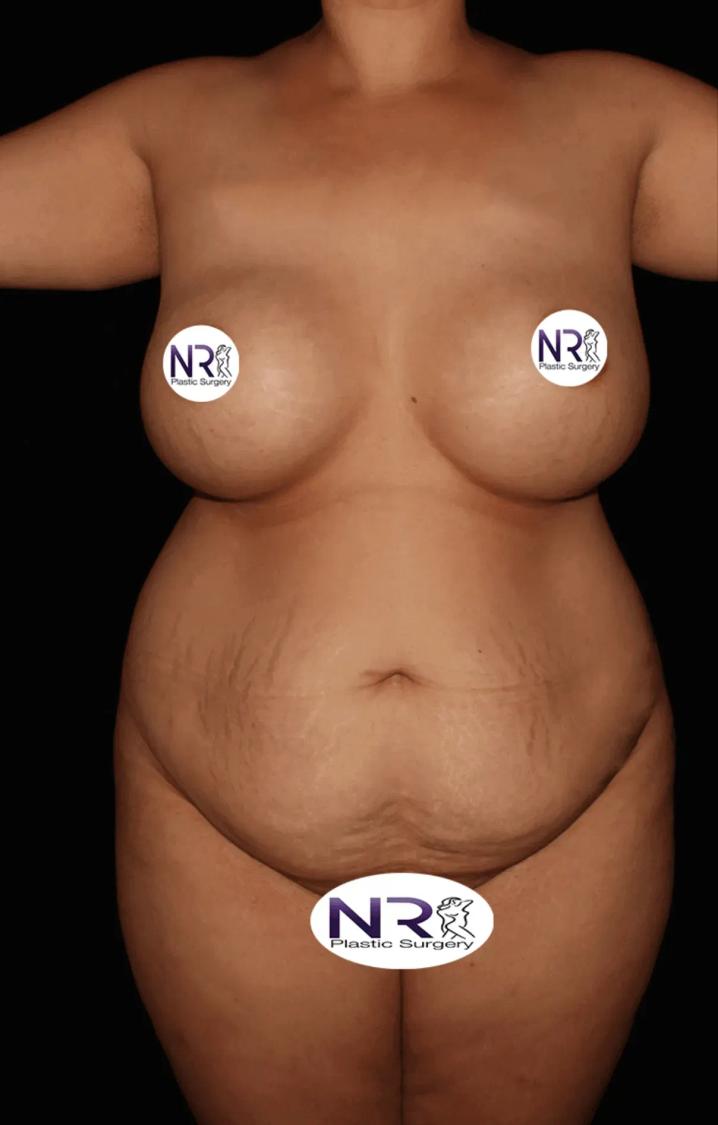 Tummy Tuck before