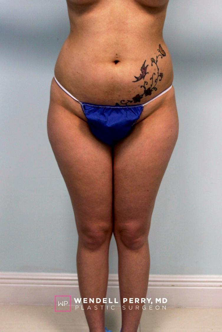 Liposuction before