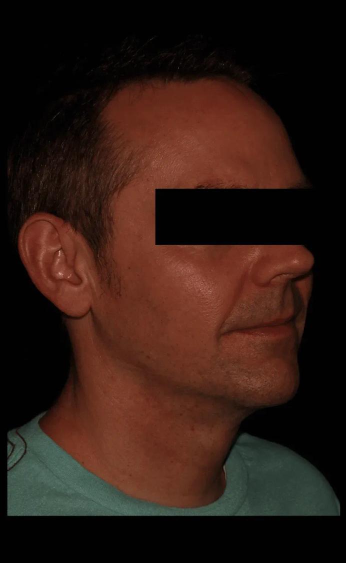 Neck Liposuction w/ Magic Tight after