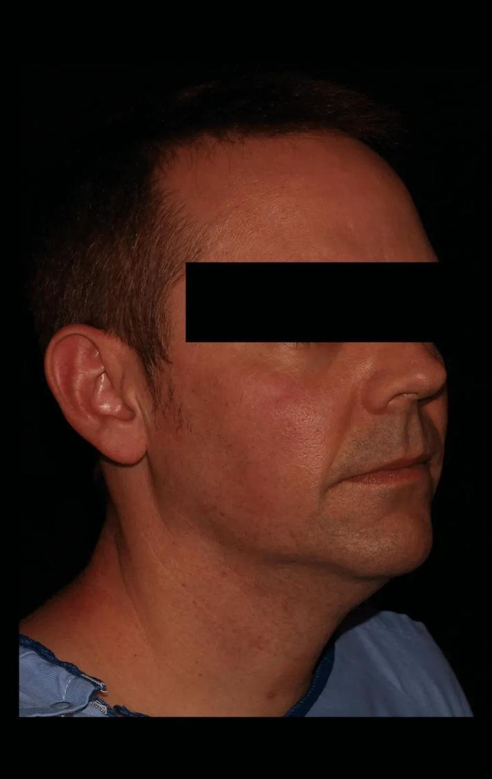 Neck Liposuction w/ Magic Tight before