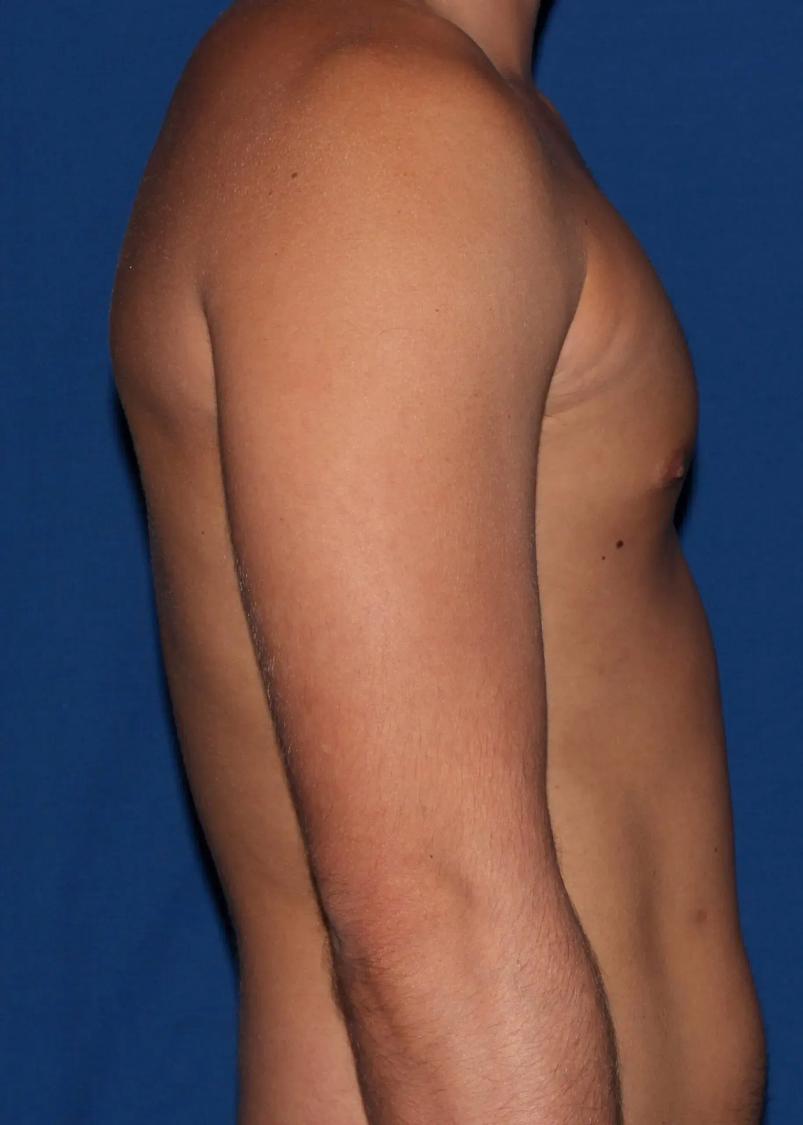 One-Stitch Gynecomastia after