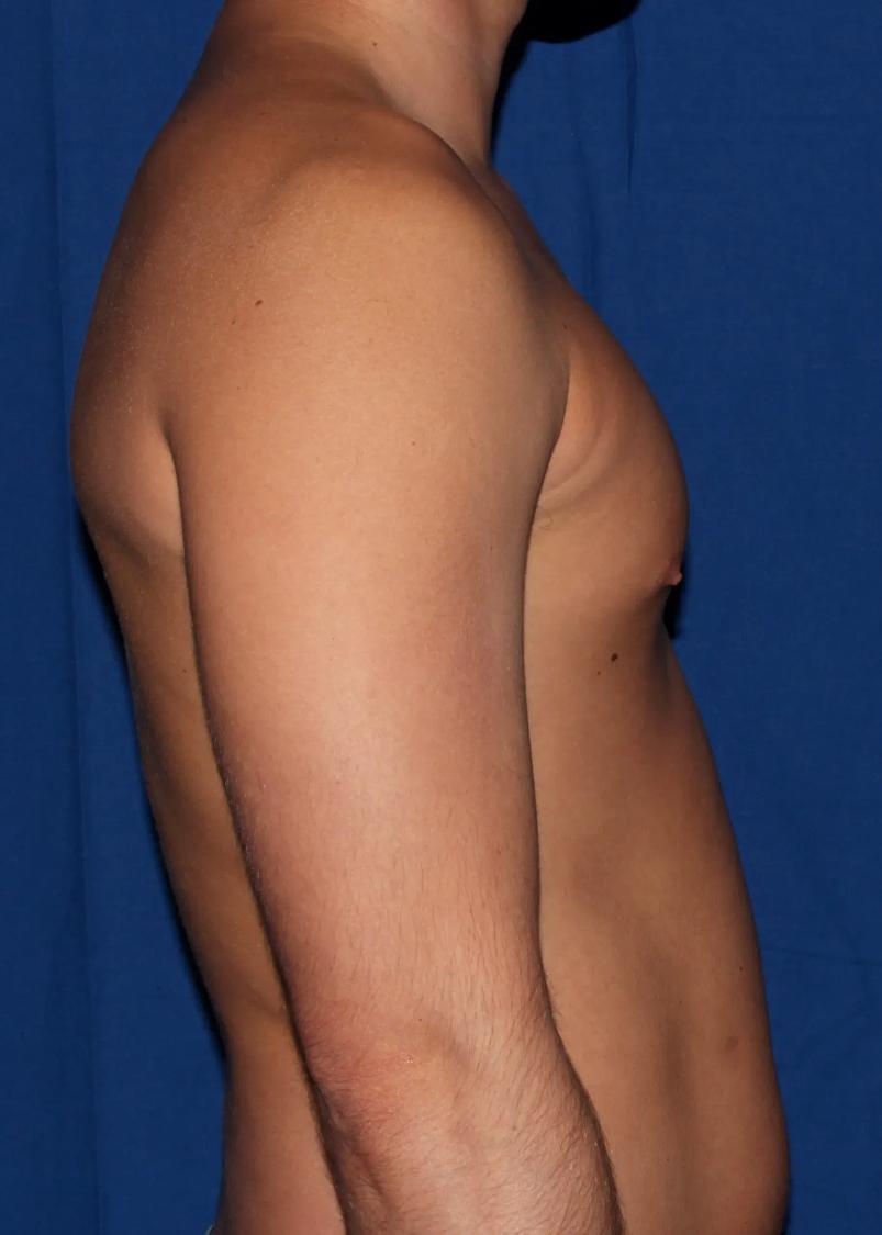 One-Stitch Gynecomastia before