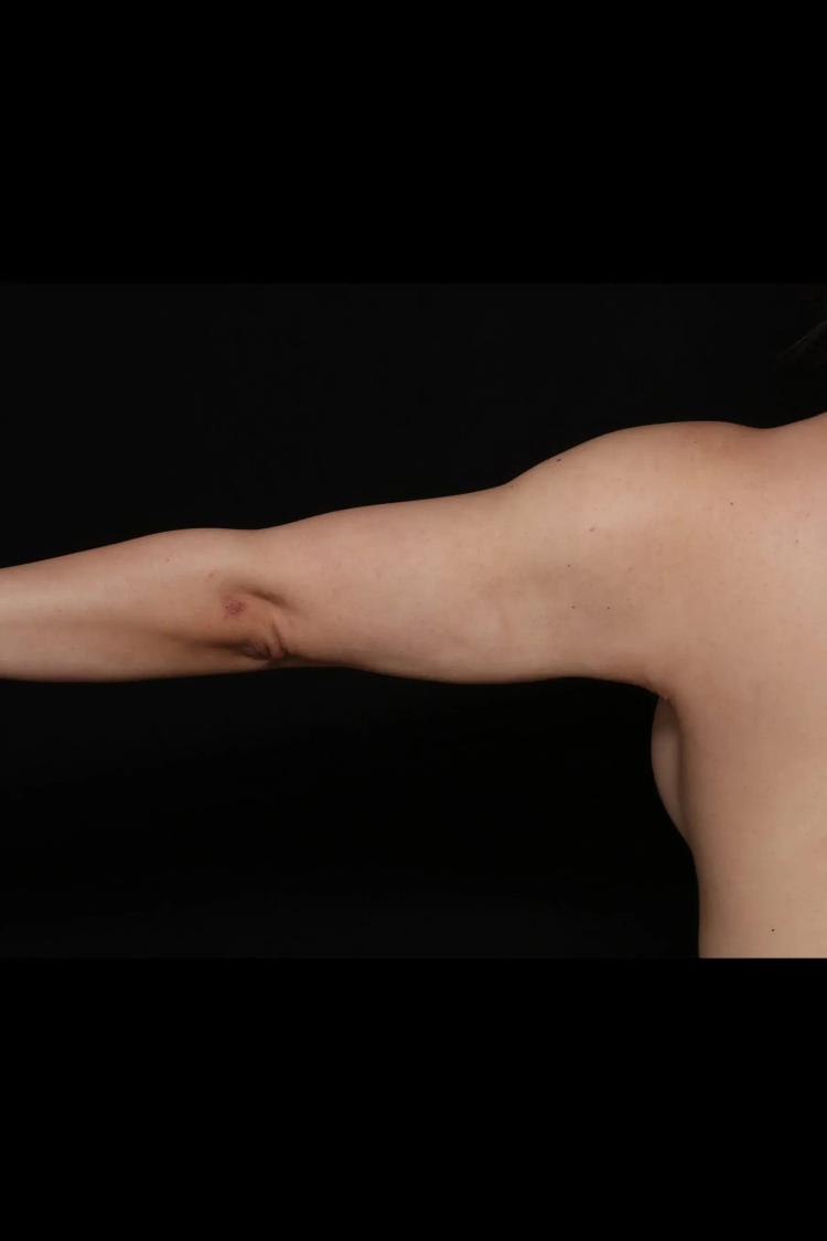 Arm Lift, view 2, after