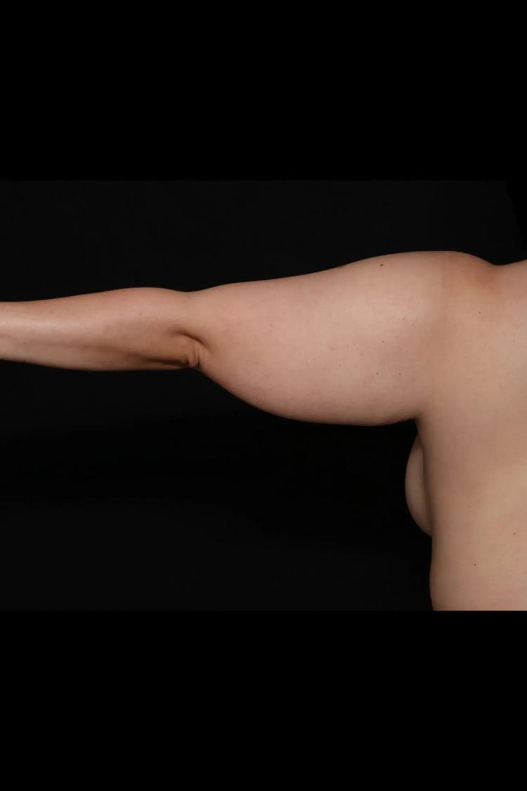 Arm Lift, view 2, before