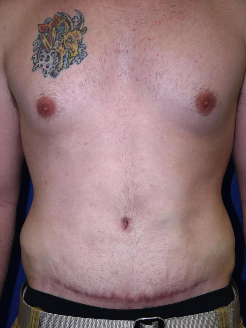 Tummy Tuck after