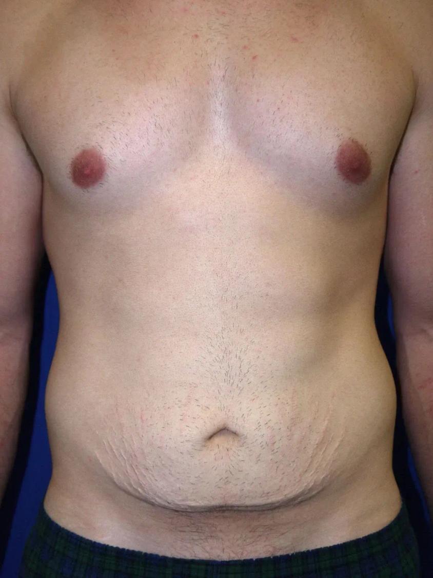 Tummy Tuck before