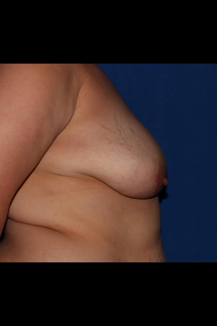 Fat Transfer To the Breast, view 2, before