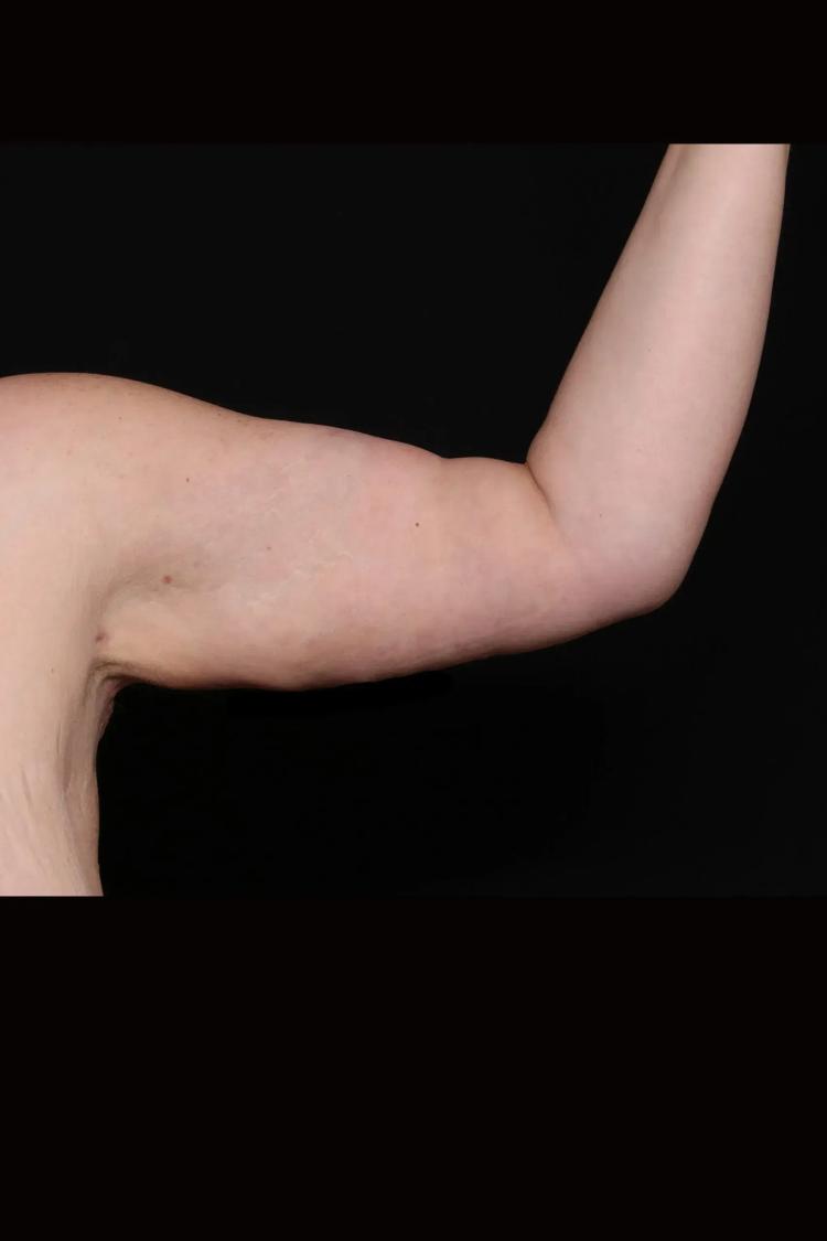 Arm Lift after