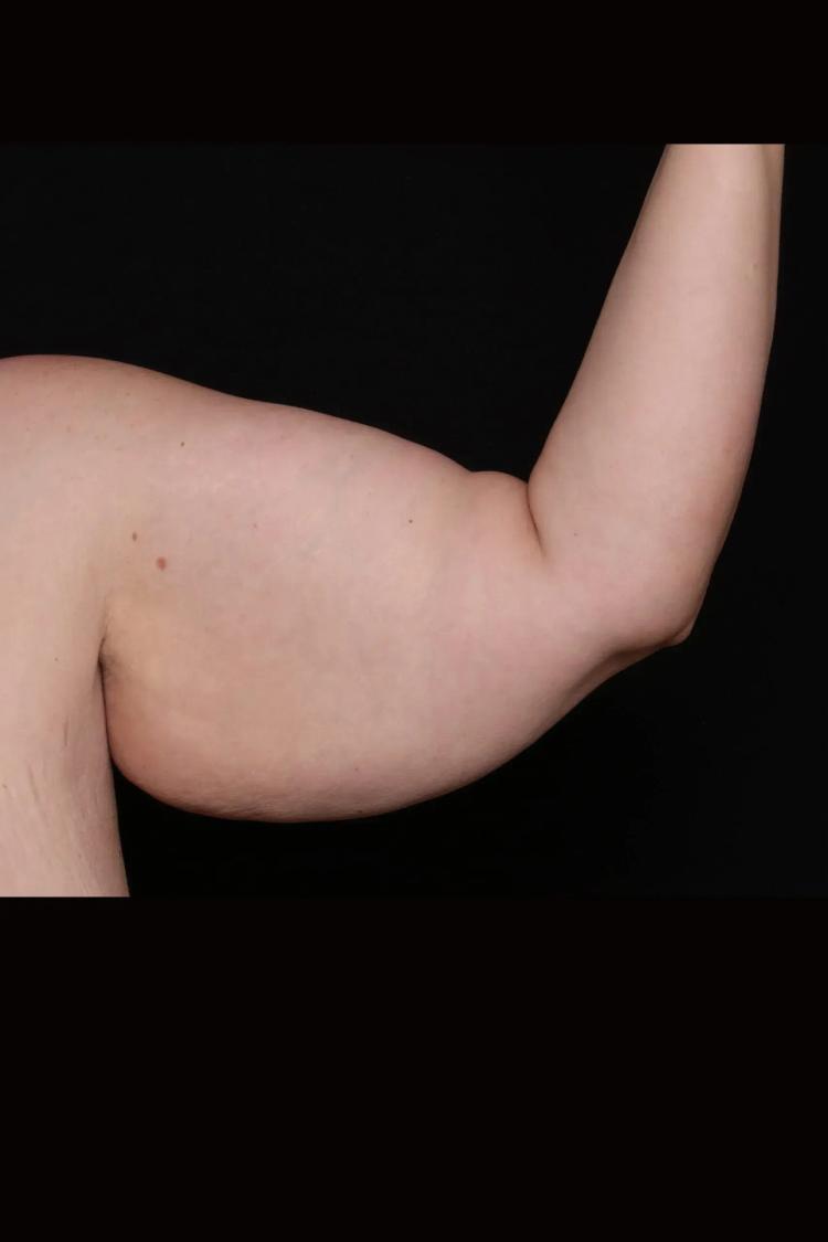 Arm Lift before