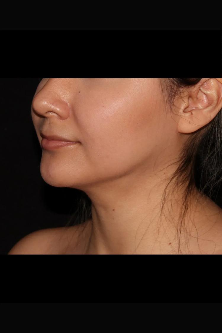 Neck Liposuction w/ Magic Tight after