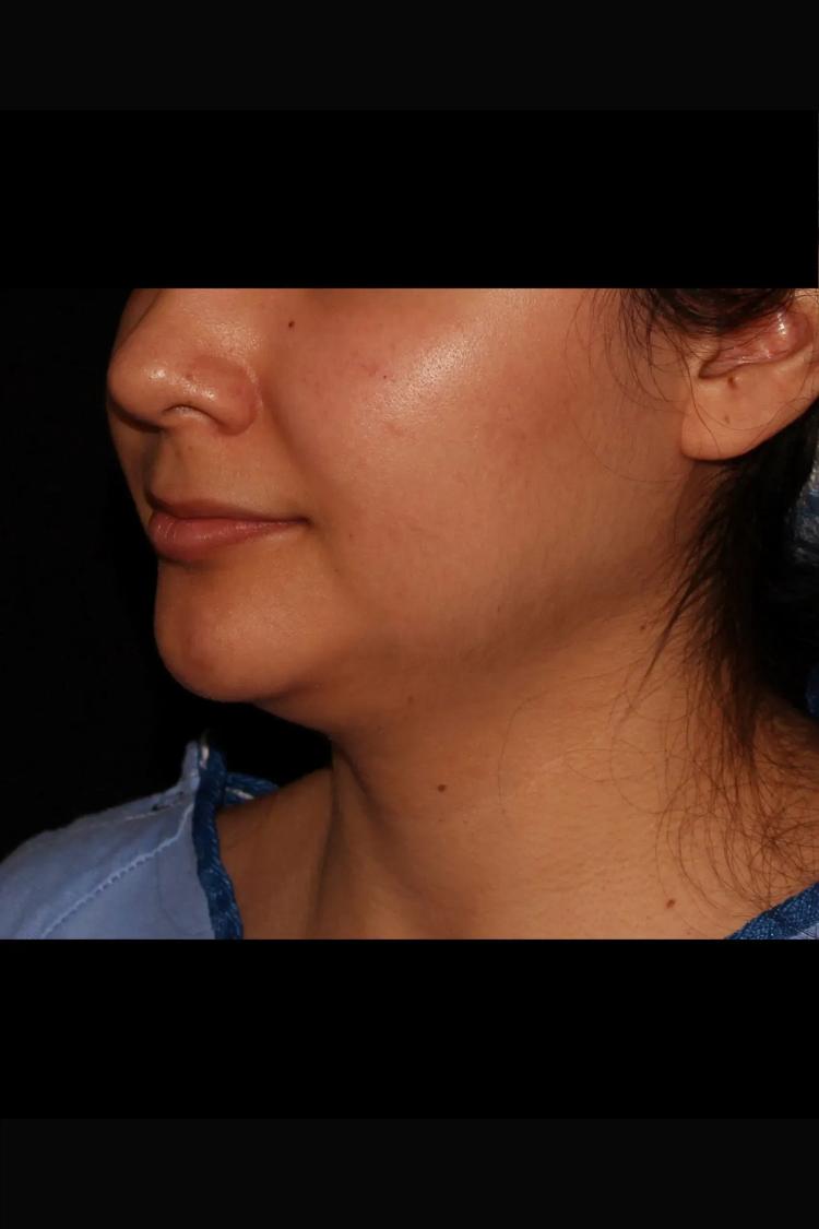 Neck Liposuction w/ Magic Tight before