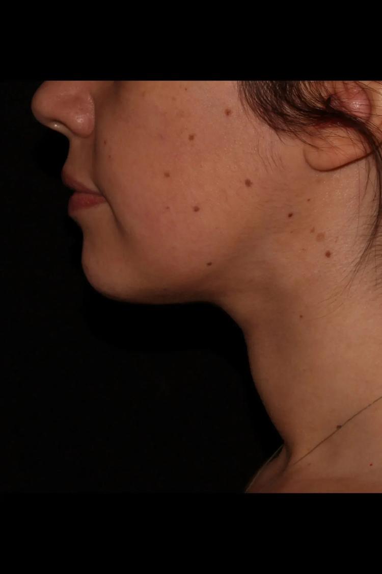 Buccal Fat Pad Removal, view 3, after