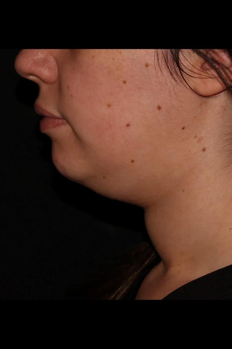 Buccal Fat Pad Removal, view 3, before