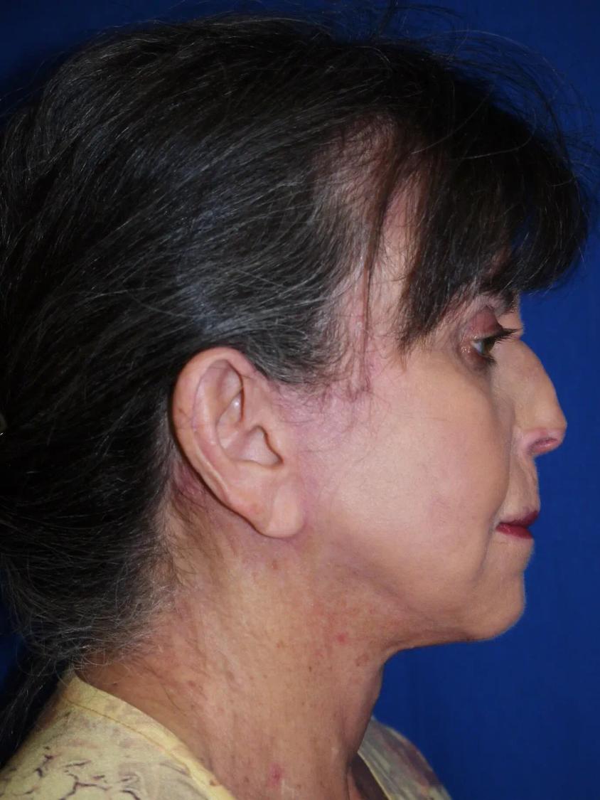 Facelift (neck lift included), view 2, after