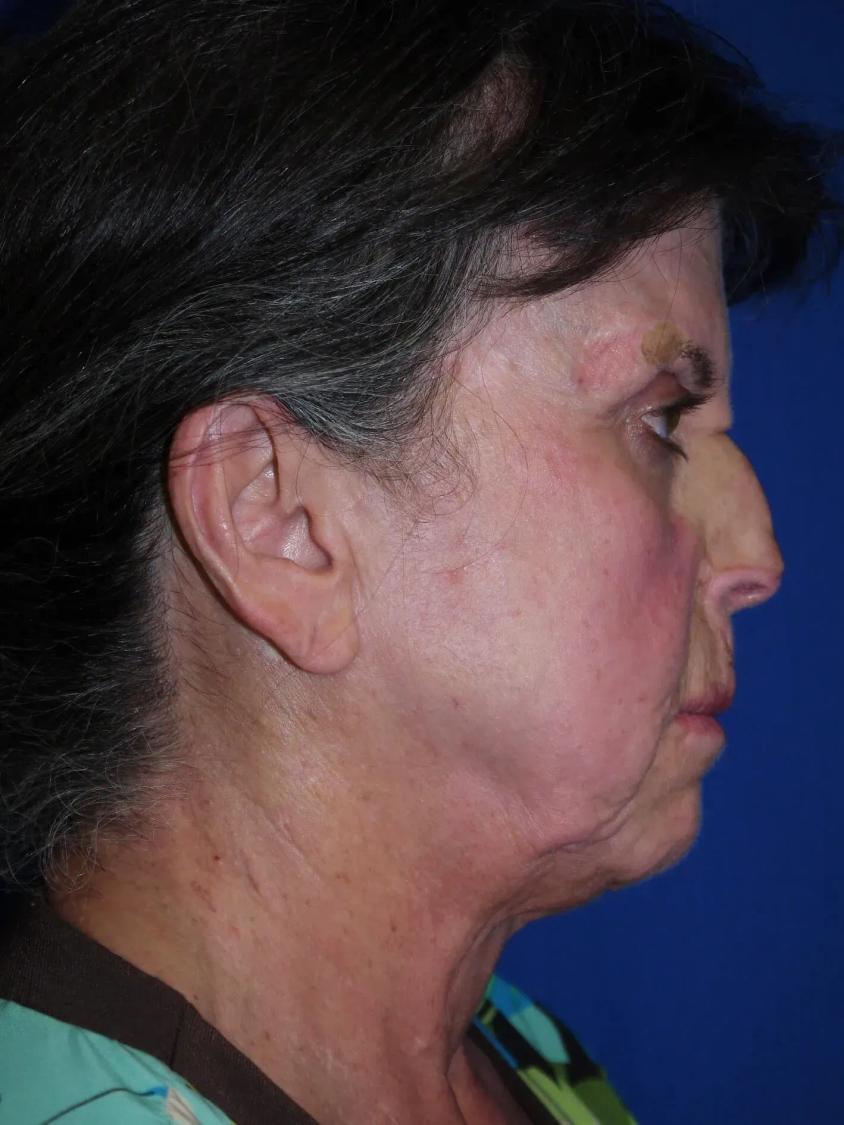 Facelift (neck lift included), view 2, before