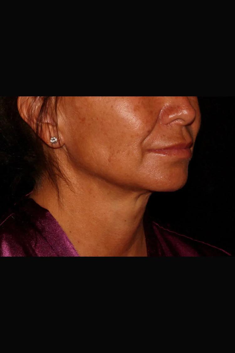 Neck Liposuction w/ Magic Tight after