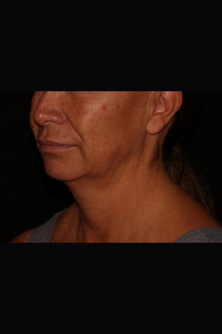 Neck Liposuction w/ Magic Tight before