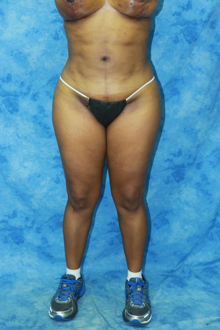 Liposuction after