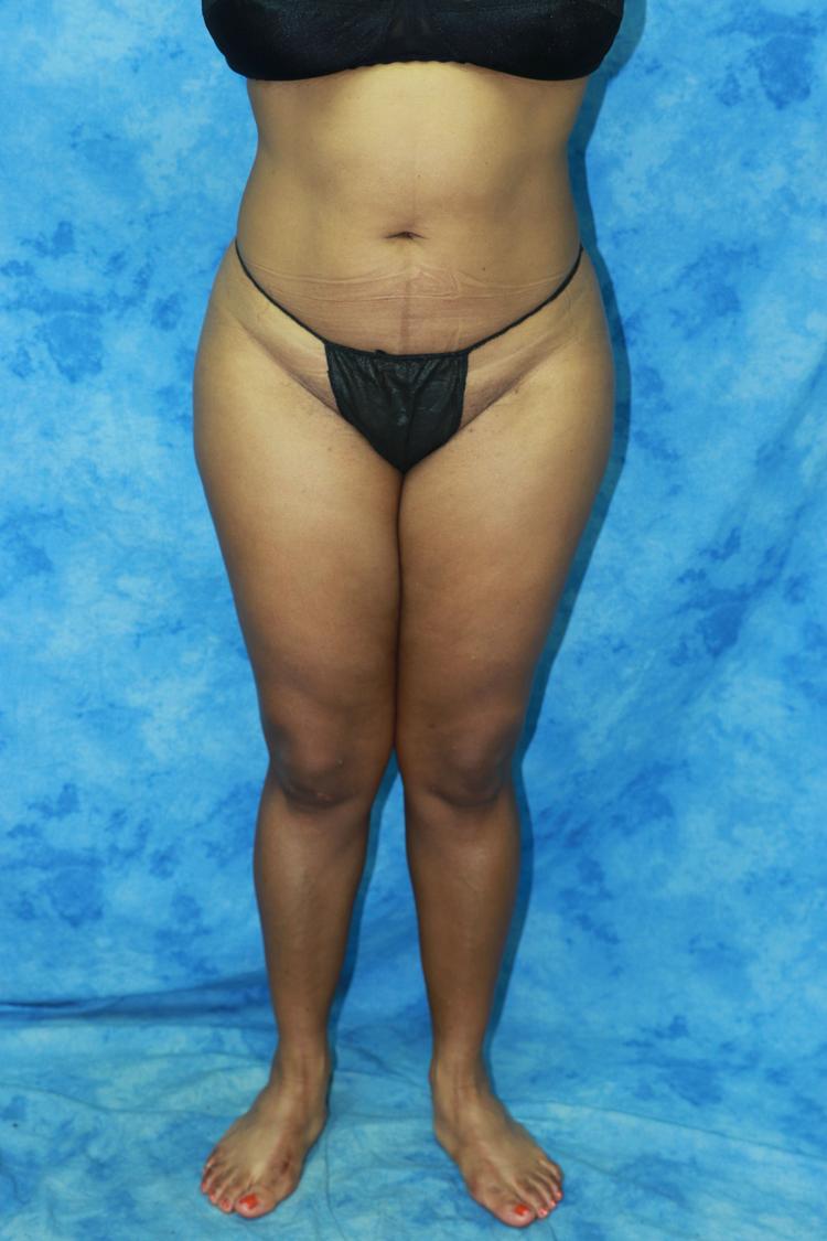 Liposuction before
