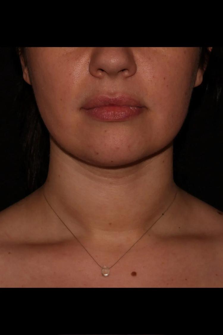 Buccal Fat Pad Removal after