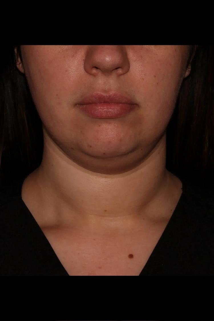 Buccal Fat Pad Removal before