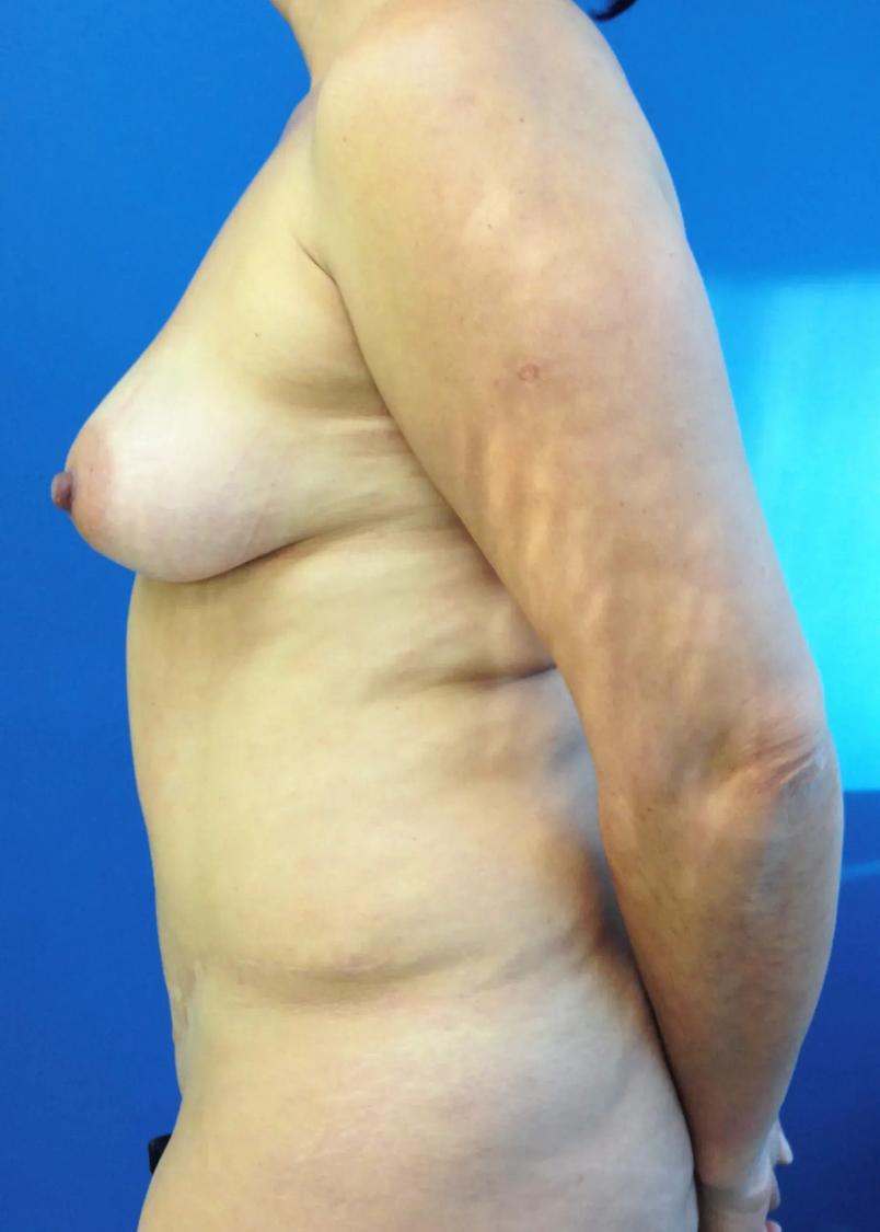 Tummy Tuck, view 3, before