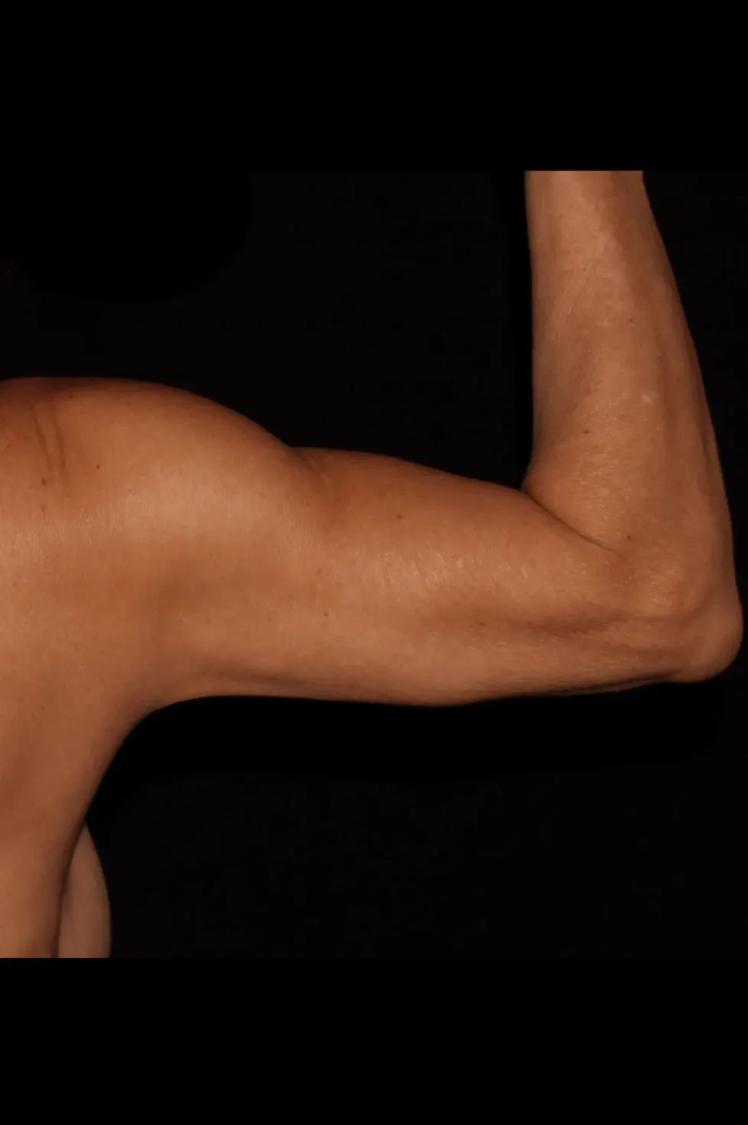 Arm Lift after