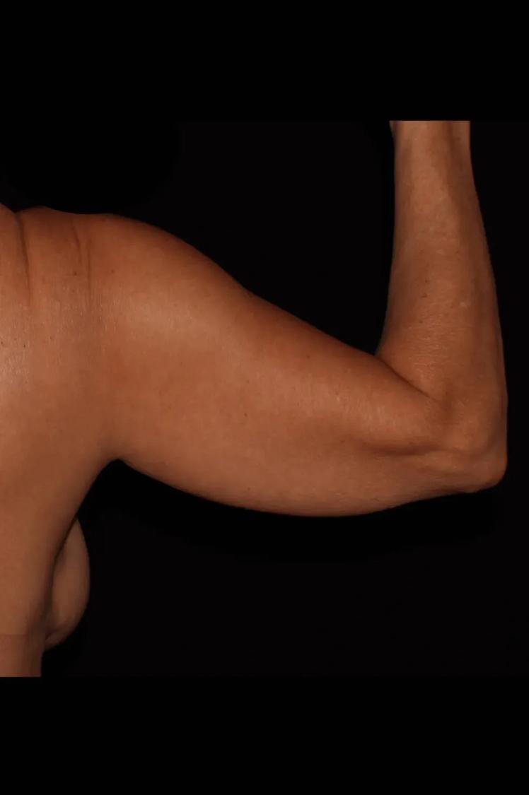 Arm Lift before