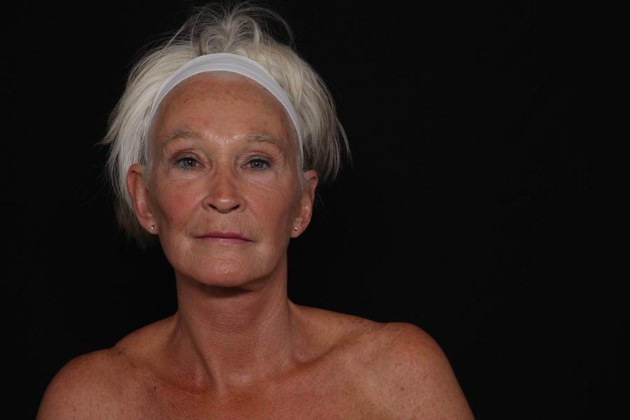 After Facelift (neck lift included)