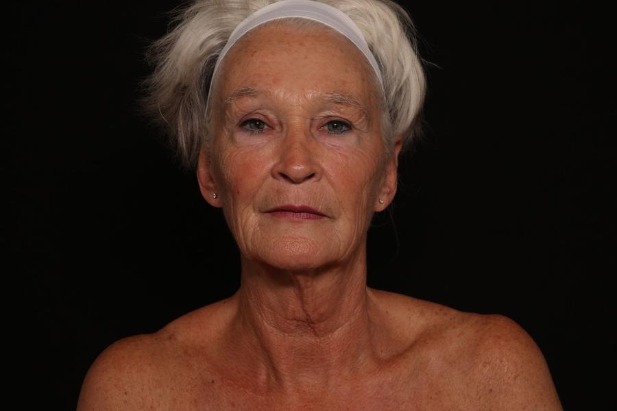 Before Facelift (neck lift included)