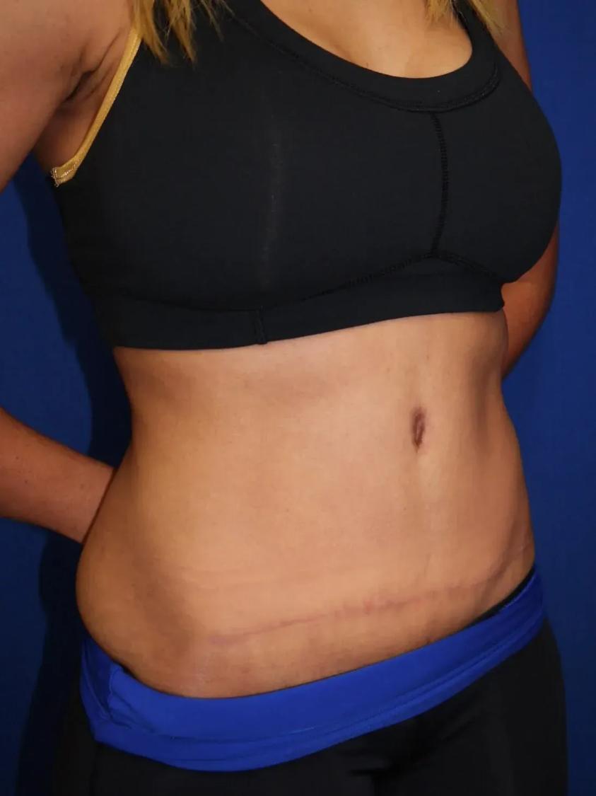 Tummy Tuck, view 2, after