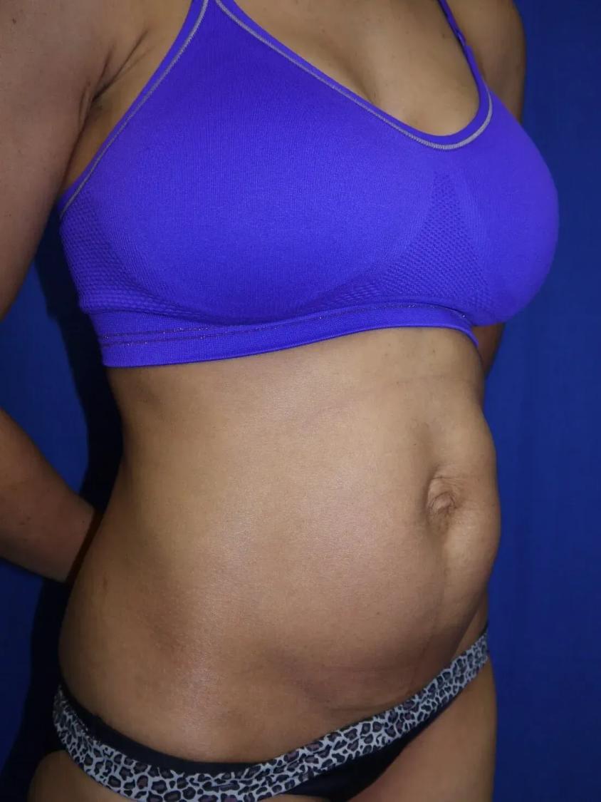 Tummy Tuck, view 2, before