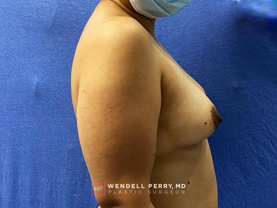 Fat Transfer To the Breast, view 3, before