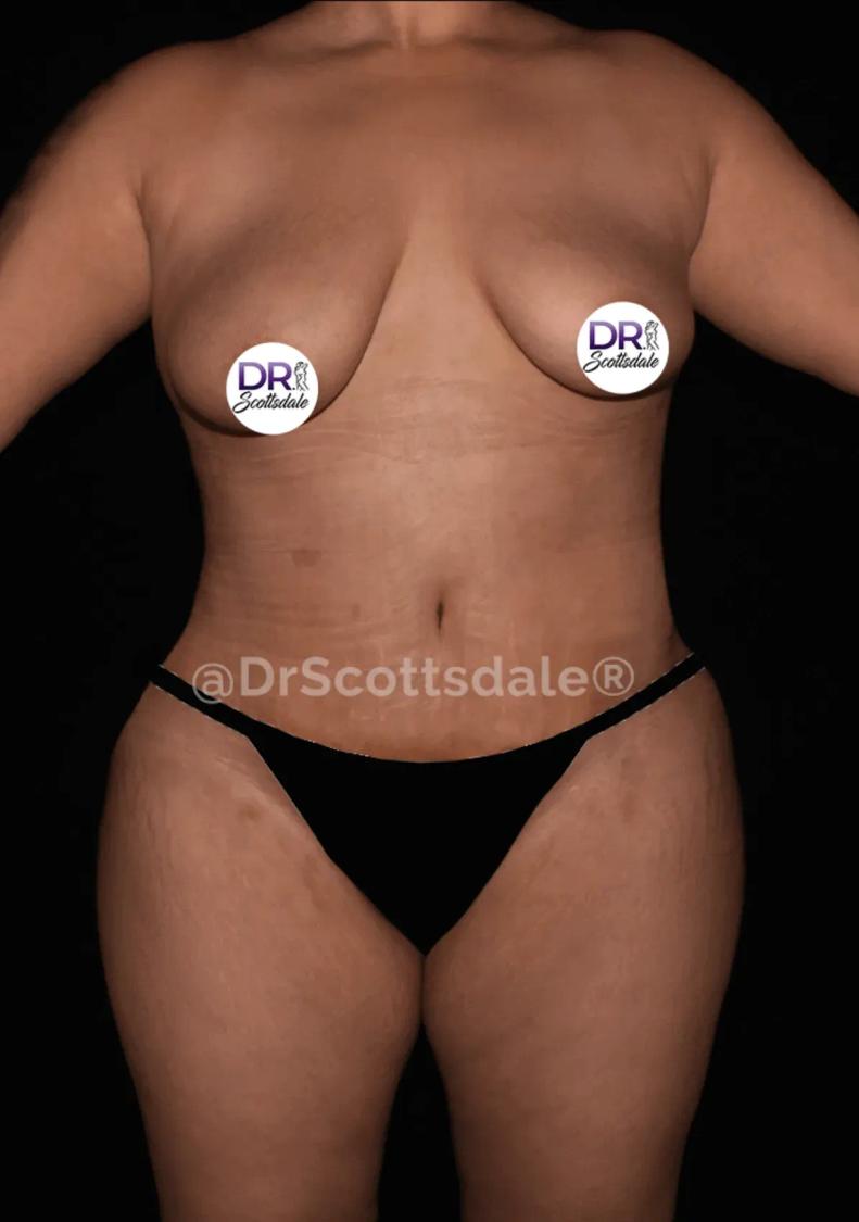 Tummy Tuck after