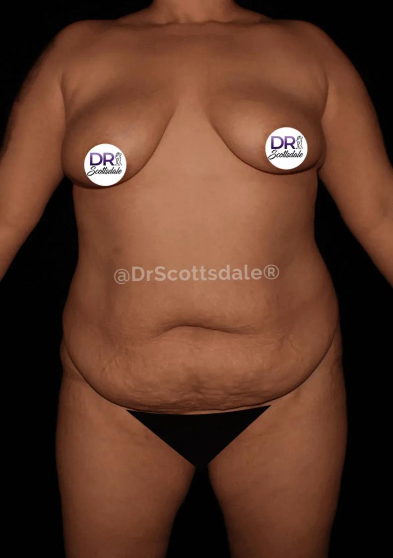 Tummy Tuck before