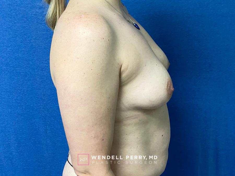 Fat Transfer To the Breast, view 3, before