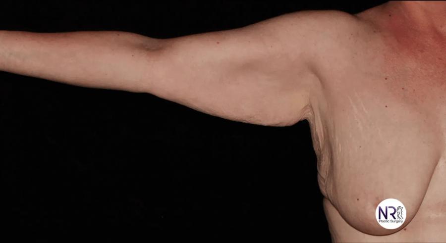 Arm Lift before