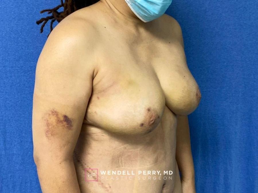 Fat Transfer To the Breast, view 2, after
