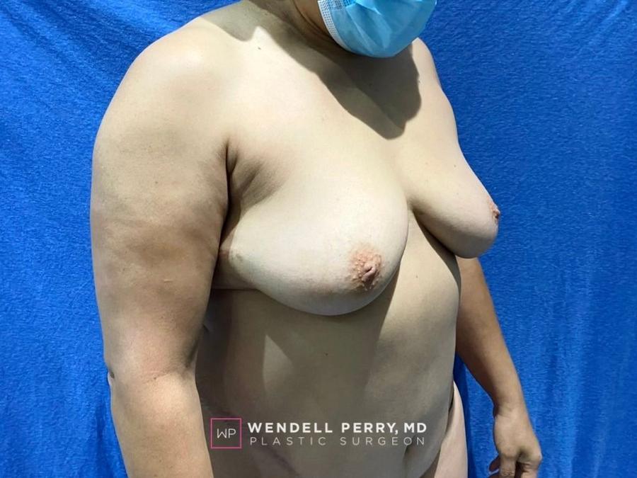 Fat Transfer To the Breast, view 2, before