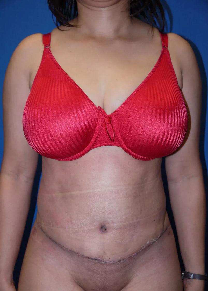Tummy Tuck after