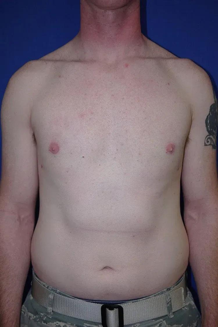 One-Stitch Gynecomastia after