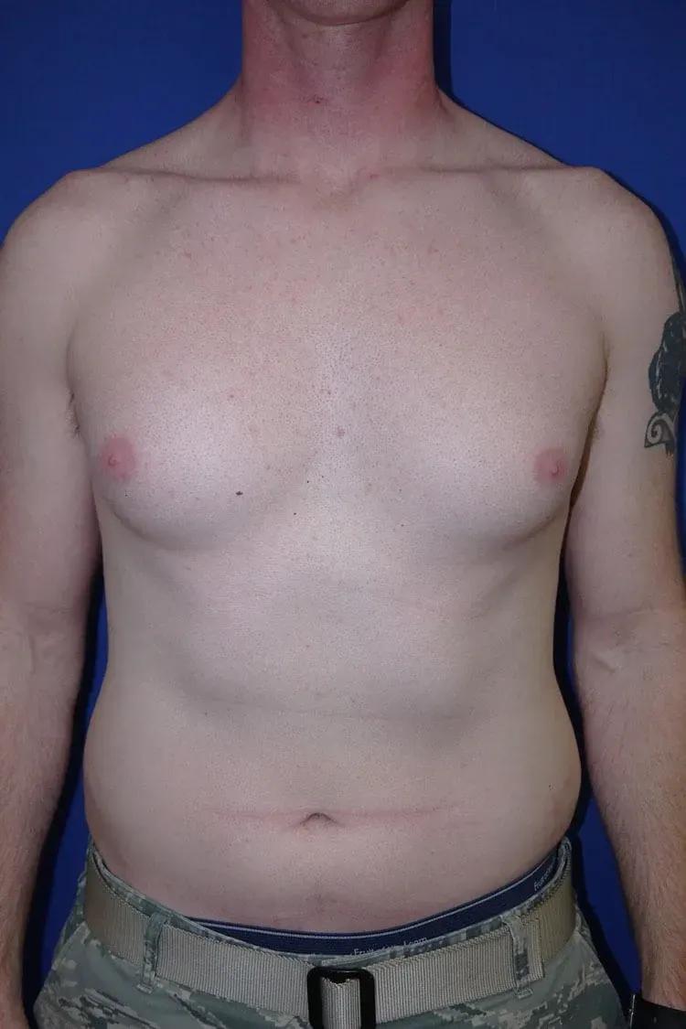 One-Stitch Gynecomastia before