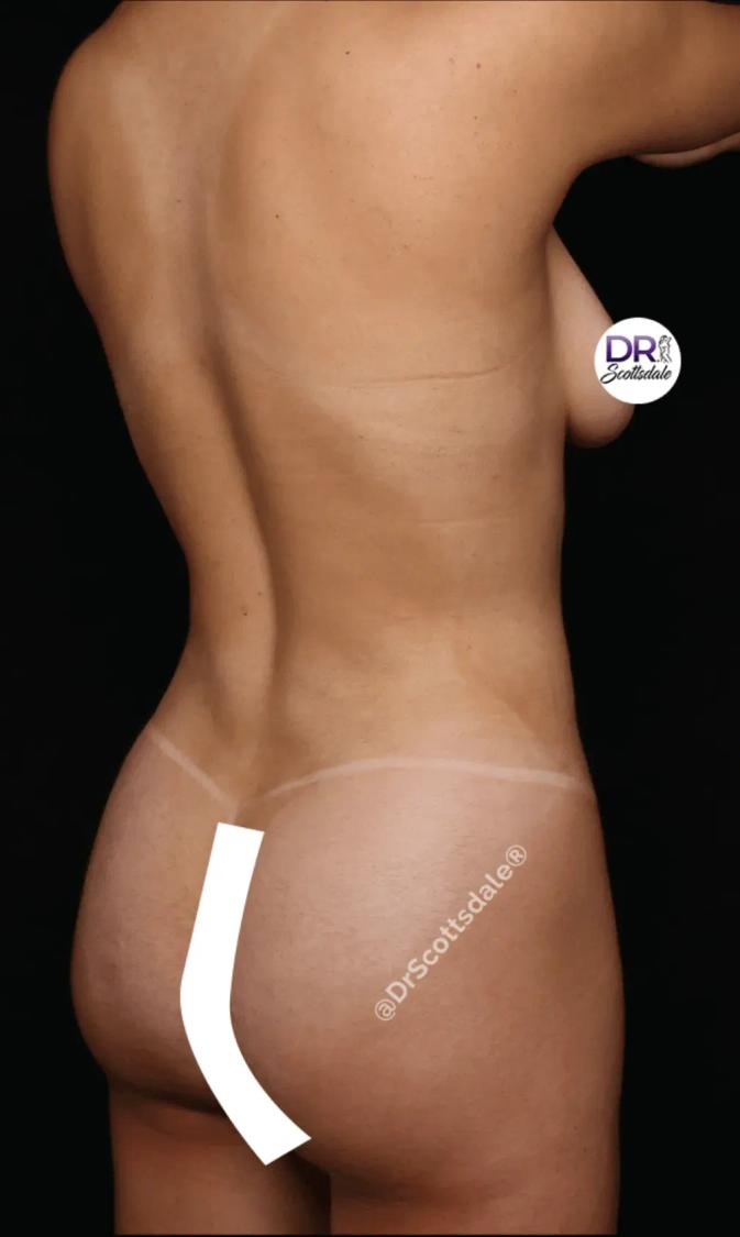 Vaser Lipo 360 (5L Max), view 2, after
